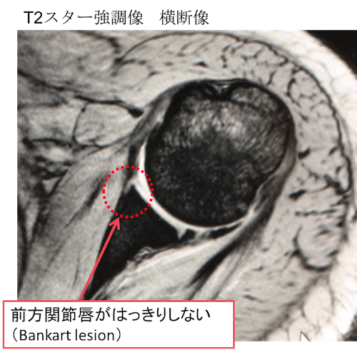 反復性肩関節脱臼のCT,MRI画像診断のポイントは？